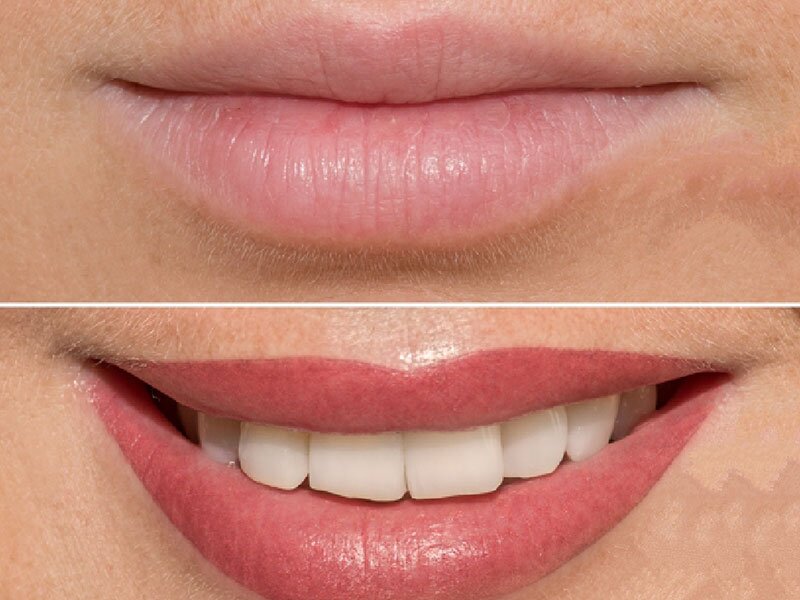 home-lip-tint-img2-dermalyn